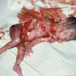 Cywilizacja śmierci: masowe aborcje wśród nastolatek